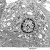 9D5 Metastasis, amelanotic melanoma (Case 9) EM 024 - Copy