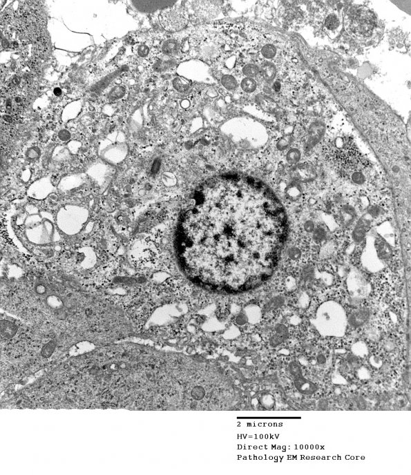 9D5 Metastasis, amelanotic melanoma (Case 9) EM 024 - Copy