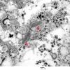 9D6 Metastasis, amelanotic melanoma (Case 9) EM 025a copy - Copy