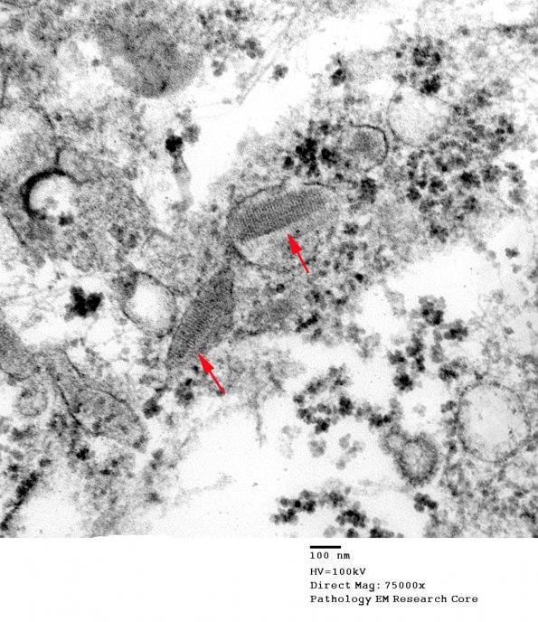 9D6 Metastasis, amelanotic melanoma (Case 9) EM 025a copy - Copy