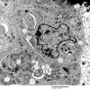 9D7 Metastasis, amelanotic melanoma (Case 9) EM 029 - Copy