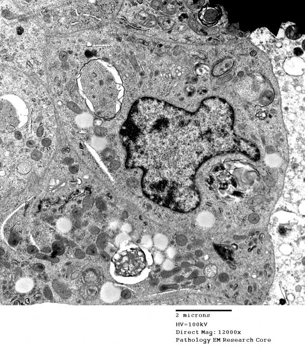 9D7 Metastasis, amelanotic melanoma (Case 9) EM 029 - Copy