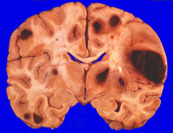 12 Melanoma (A80-105) 2