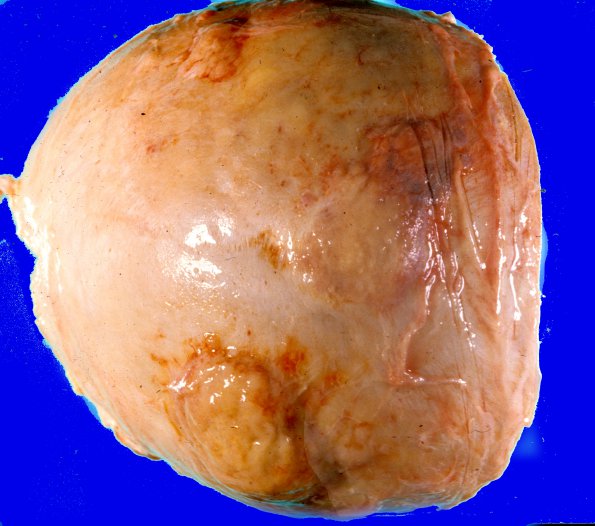 10C Metastases (Metastasis, dura, (Case 10C) skull