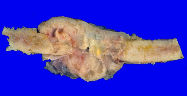 10E Metastases (Case 10E) lung