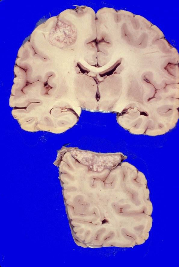 10F Metastases (Case 10F)