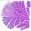 10I Metastasis, breast (Case 10I) H&E WM