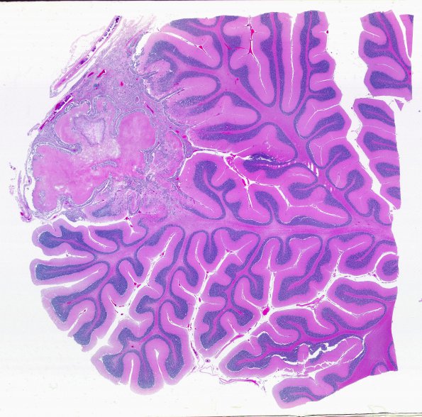 10I Metastasis, breast (Case 10I) H&E WM