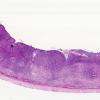 10J1 Metastasis, breast to dura, (AFIP Slide Set, 91) H&E WM