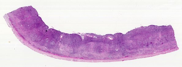 10J1 Metastasis, breast to dura, (AFIP Slide Set, 91) H&E WM