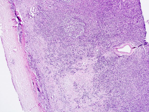 10J2 Metastasis, breast to dura, (AFIP Slide Set, 91) H&E 1