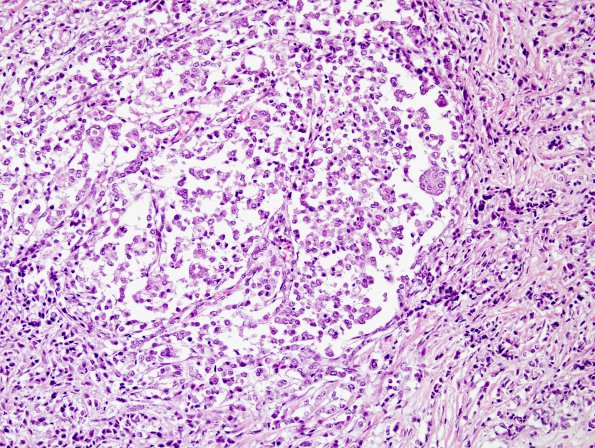 10J3 Metastasis, breast to dura, (AFIP Slide Set, 91) H&E 2