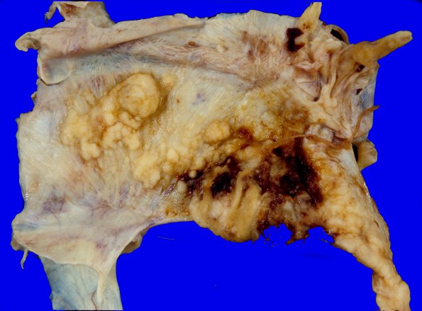 10L Metastasis, NOS, Dura (Case 10L)