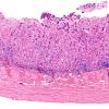 10M Metastasis, lung, focal lepto (Case 10M) dura H&E