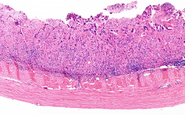 10M Metastasis, lung, focal lepto (Case 10M) dura H&E