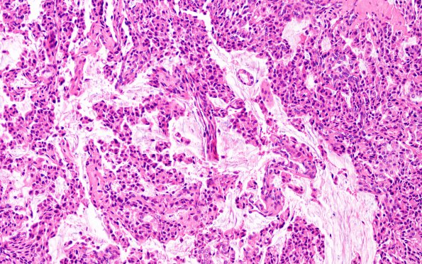 10N Metastasis, prostate (Case 10N) dura H&E 2