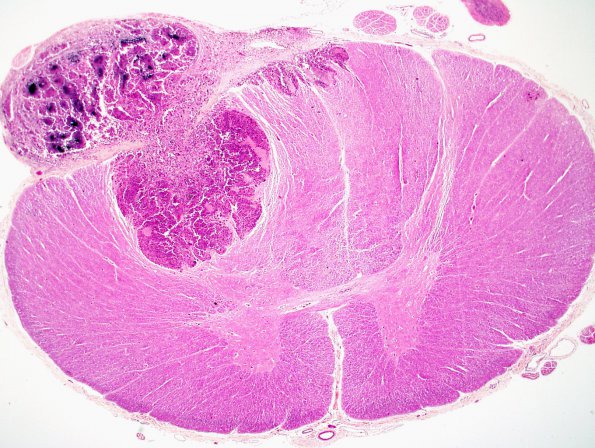 10P Metastasis, spinal cord (Case 10P) H&E 2x.jpg