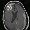 11A1 Metastatic Prostate CA (Case 11) T1 W 1 - Copy