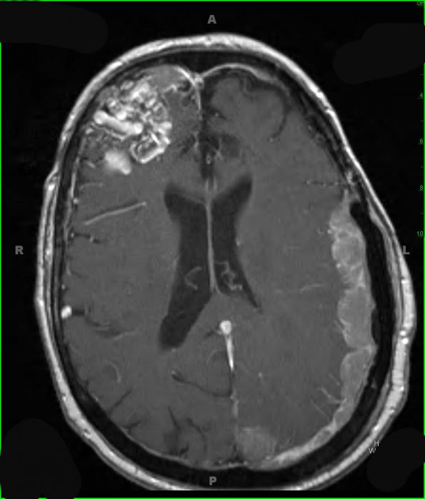 11A1 Metastatic Prostate CA (Case 11) T1 W 1 - Copy