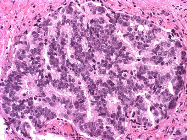 11B Metastases, Prostate (Case 11)