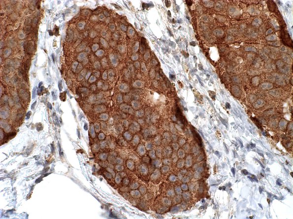 11C Metastases, Prostate (Case 11) PSAP