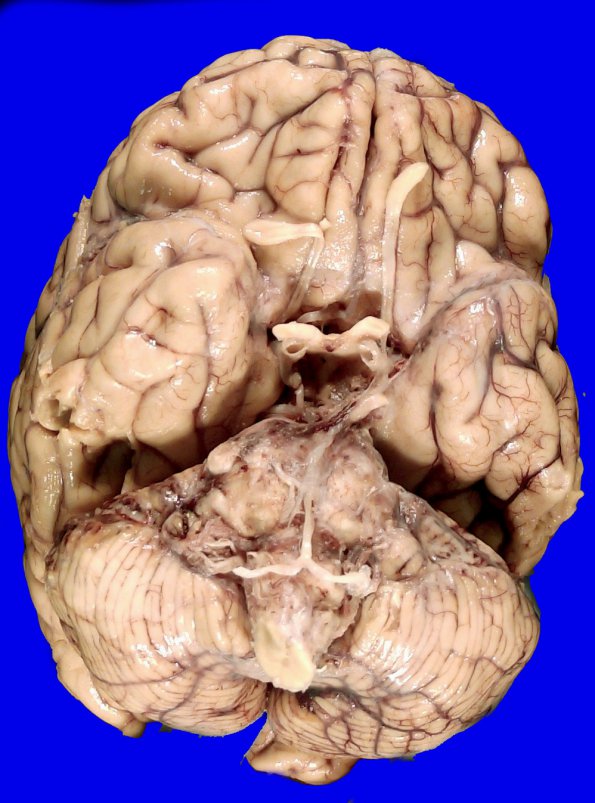 12A1 Metastasis, lepto, vulva (Case 12)  _1