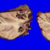 12A4 Metastasis, lepto, vulva (Case 12)    _6