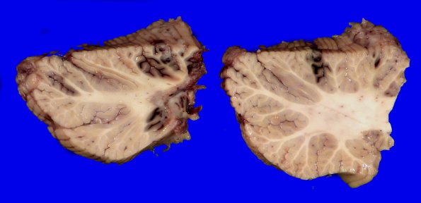 12A4 Metastasis, lepto, vulva (Case 12)    _6