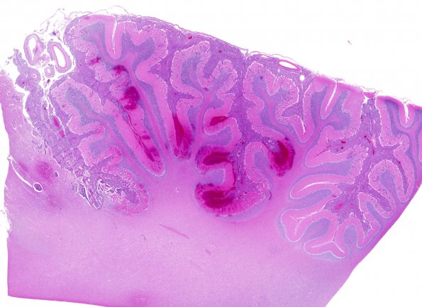 12B1 Metastasis, lepto, vulva (Case 12)  N11 H&E WM