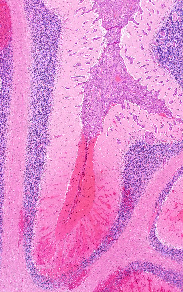 12B4 Metastasis, lepto, vulva (Case 12)  N11 H&E 4X 1A