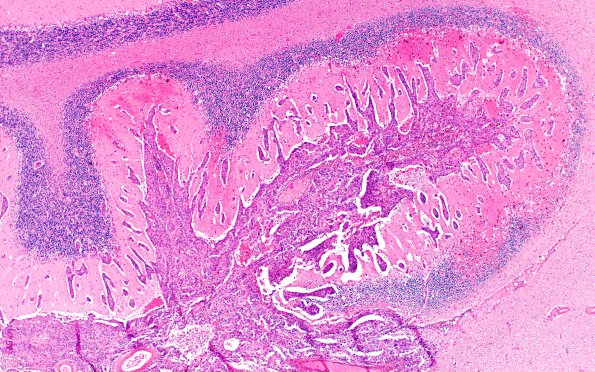 12B6 Metastasis, lepto, vulva (Case 12)  N11 H&E 4X 3