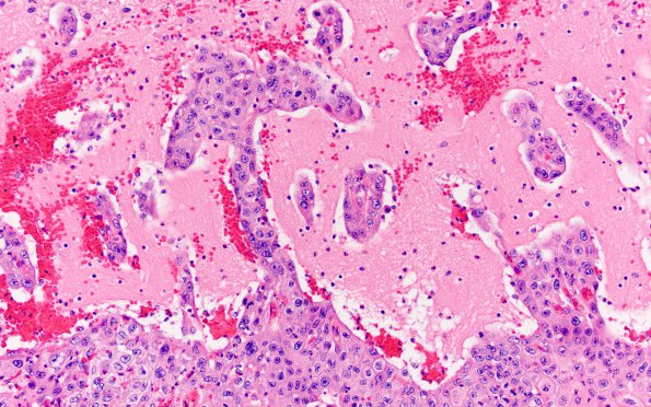 12B7 Metastasis, lepto, vulva (Case 12)  N9 H&E 20X