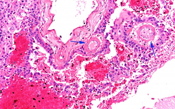 12B9 Metastasis, lepto, vulva (Case 12)  N9 H&E 20X copy