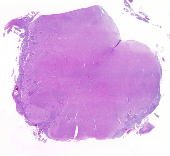 12C Metastasis, lepto, vulva (Case 12)  N8 H&E WM