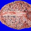 13A1 Metastasis, lung (Case 13) gross_14 copy A