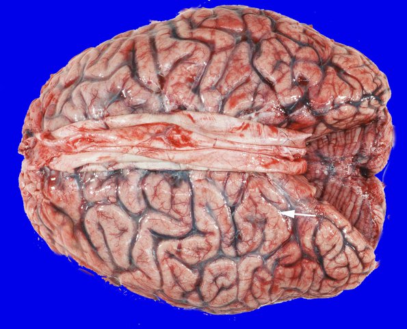 13A1 Metastasis, lung (Case 13) gross_14 copy A