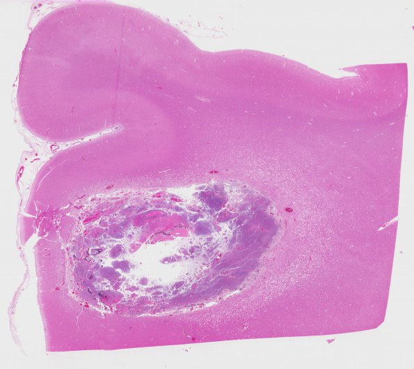 13B1 Metastasis, lung (Case 13) H&E WM