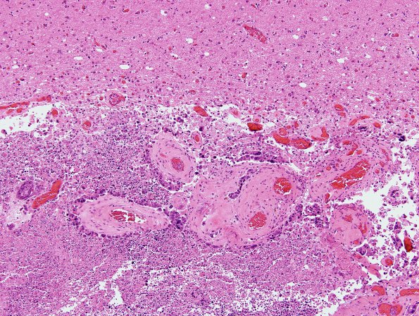 13B2 Metastasis, lung (Case 13) H&E 1