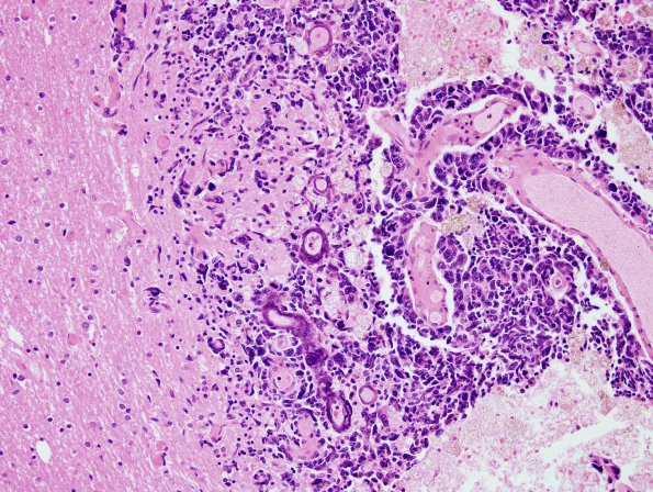 13B3 Metastasis, lung (Case 13) H&E 4