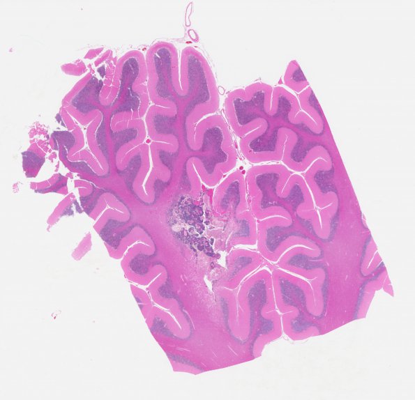 13C1 Metastasis, lung (Case 13) H&E WM