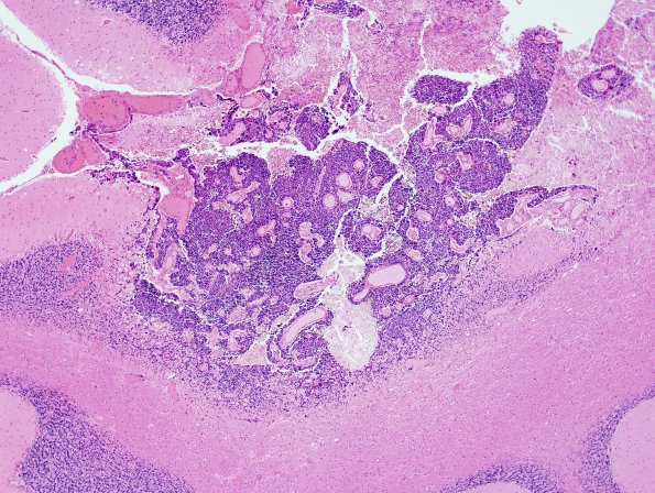 13C2 Metastasis, lung (Case 13) H&E 5