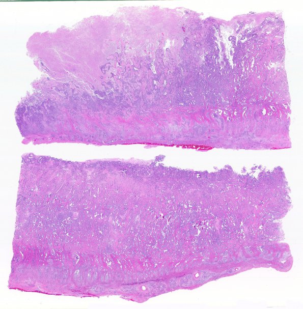 14B1 Metastasis, lung (Case 14) dura H&E WM