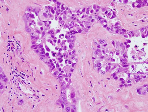 14B2 Metastasis, lung (Case 14) dura H&E 3