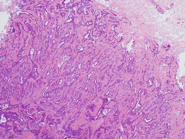 14B3 Metastasis, lung (Case 14) dura H&E 9