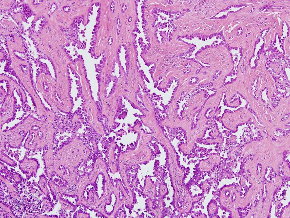 14B4 Metastasis, lung (Case 14) dura H&E 1