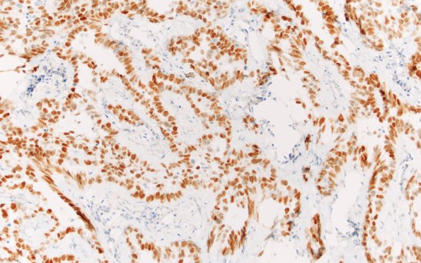 14D2 Metastasis, lung (Case 14) TTF1 20X