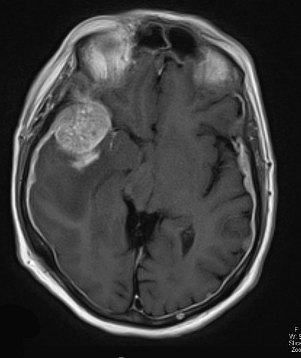 15A1 Metastasis, meninges, prostate (Case 15) dura T1 W 2 - Copy - Copy