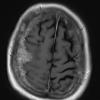 15A2 Metastasis, meninges, prostate (Case 15) dura T1 W 5 - Copy - Copy