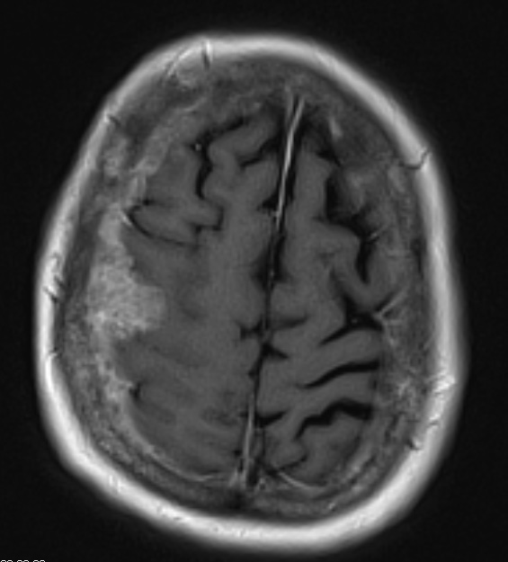 15A2 Metastasis, meninges, prostate (Case 15) dura T1 W 5 - Copy - Copy