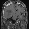 15A3 Metastasis, meninges, prostate (Case 15) dura T1 W 6 - Copy - Copy